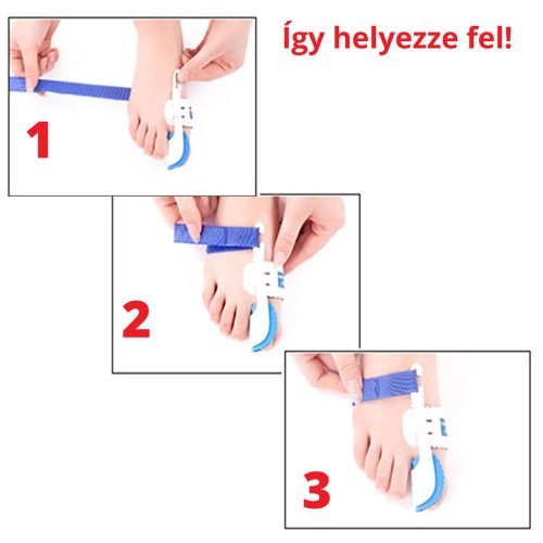 Éjszakai bütyökkorrigáló sín  (1 pár)